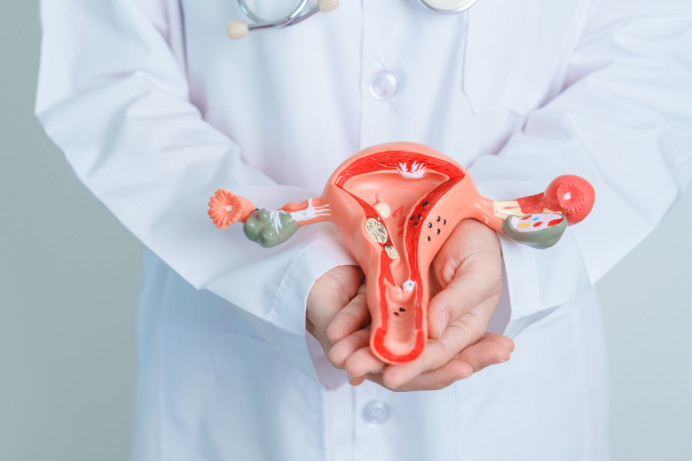 Ilustração de focos de endometriose na pelve